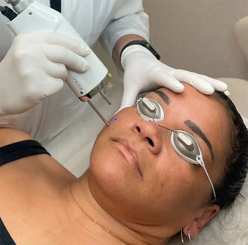 Laser handpiece positioned near a client's cheek