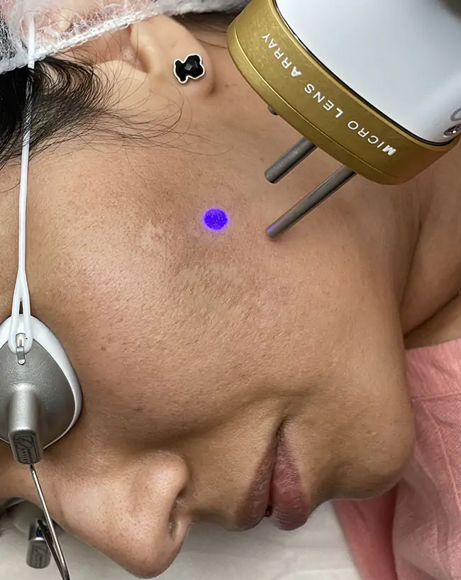 Laser handpiece positioned near a client's cheek during treatment