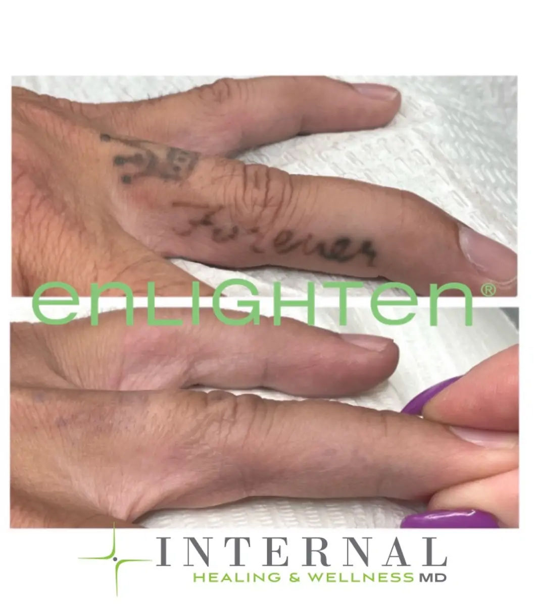 Before-and-after finger tattoo removal comparison