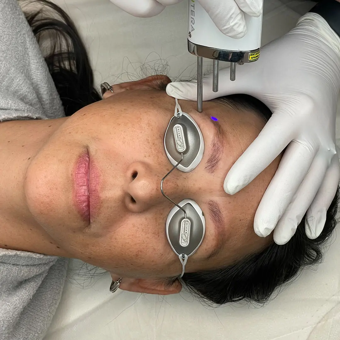 Laser treatment being performed near an eyebrow